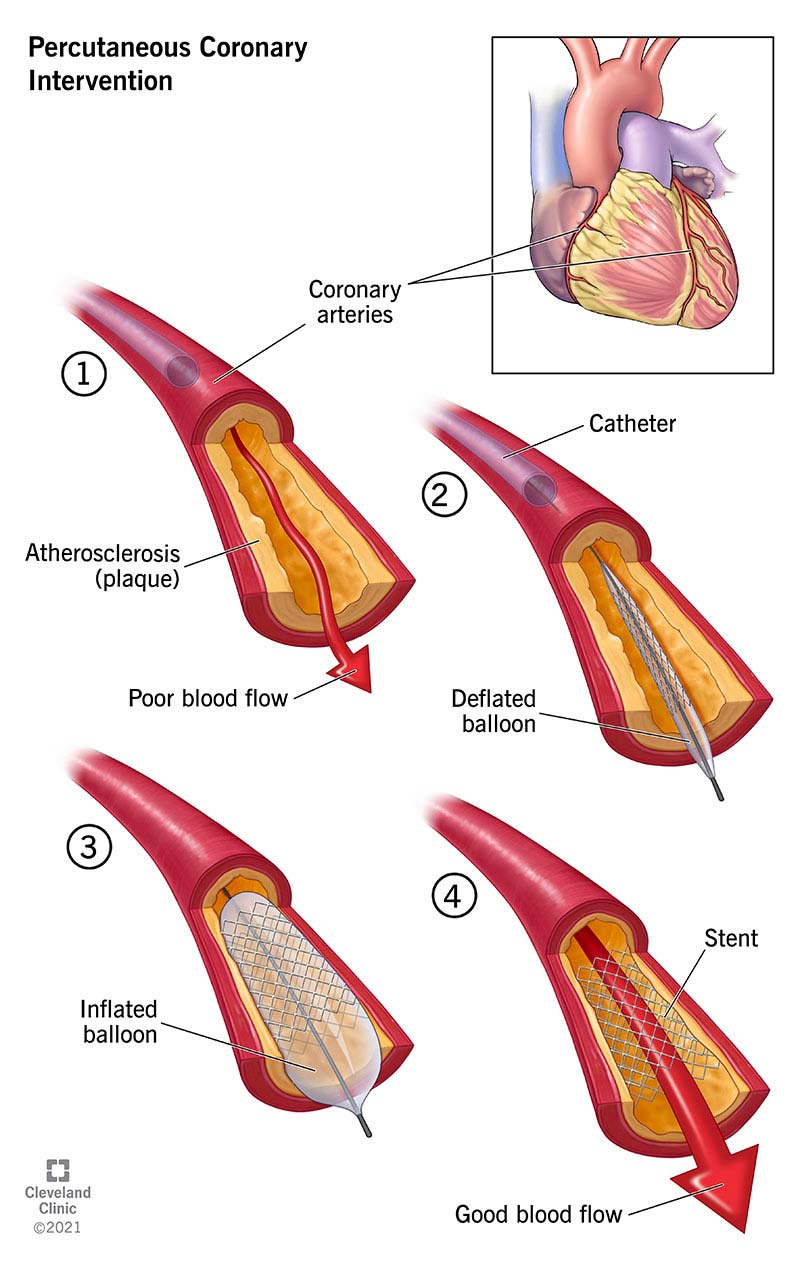 Un'illustrazione passo passo dell'intervento coronarico percutaneo (PCI).