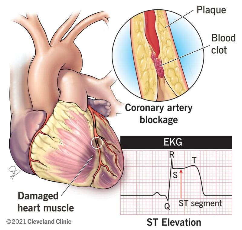 22068 stemi heart attack illustration