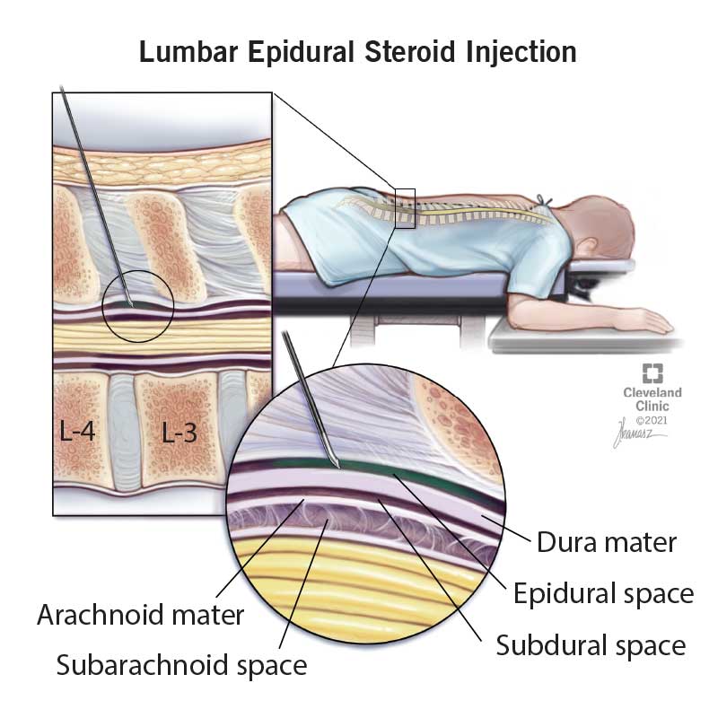 22091 lumbar spine epidural injection final