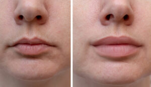 22133 lip fillers 1177813558