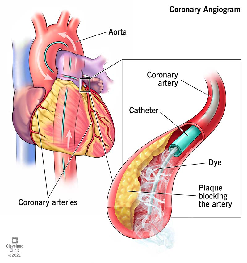 22164 coronary angiogram illustration