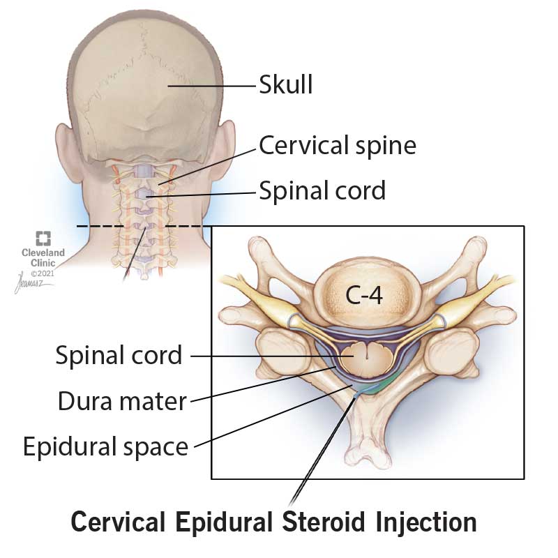 22293 cervical spine epidural injection final