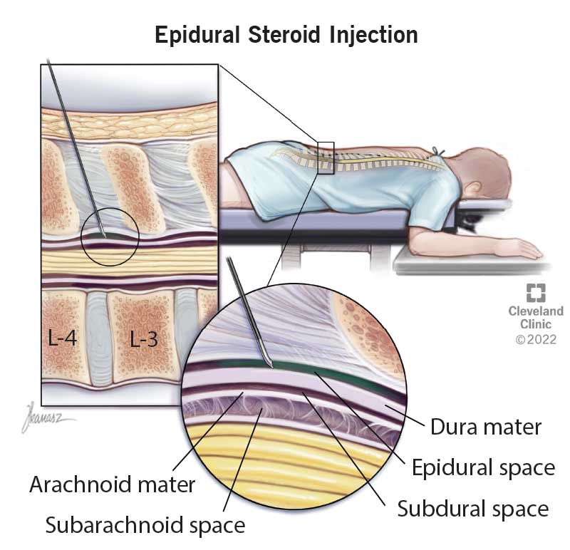 22301 epidural steroid injection final