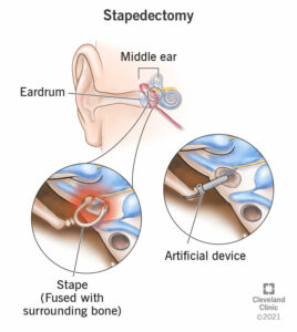 22382 stapedectomy