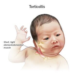 22430 torticollis