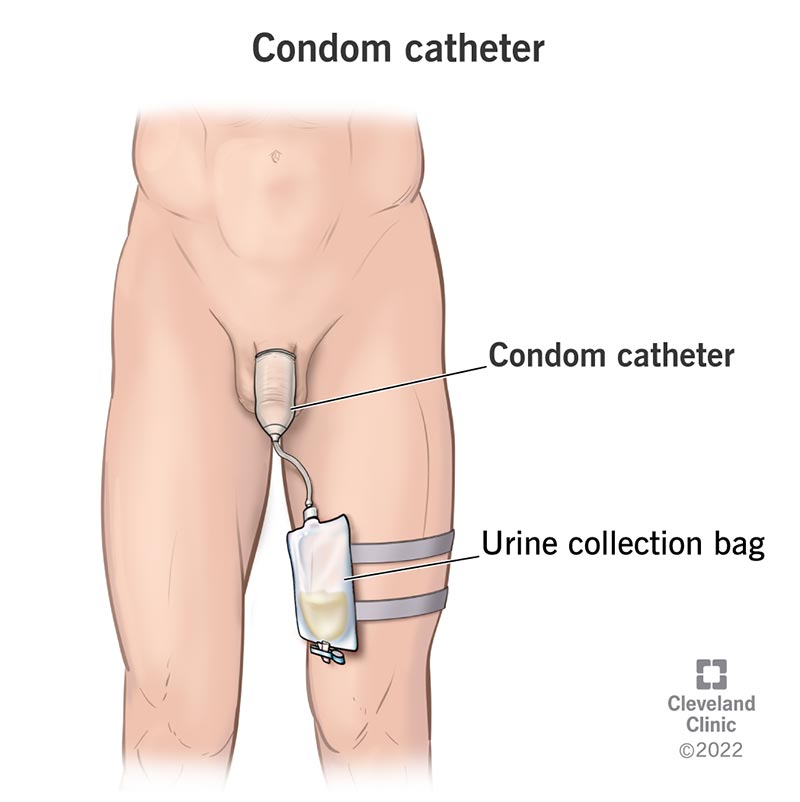 22475 condom catheter