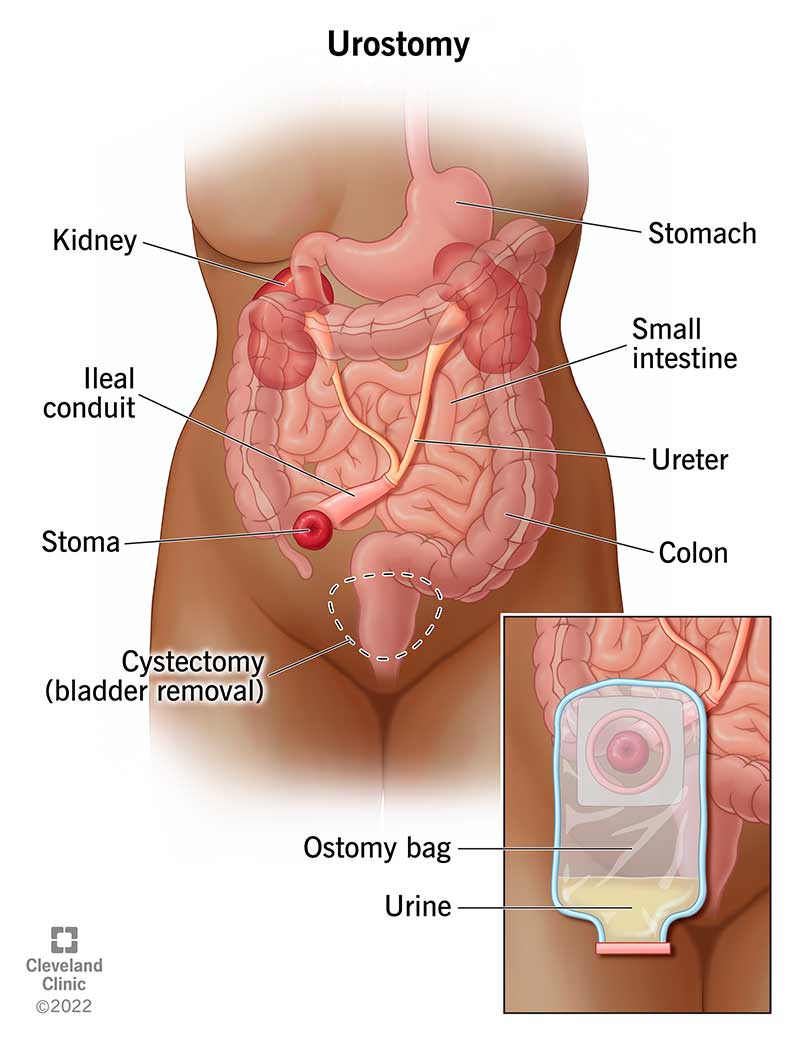 Se la tua vescica urinaria viene rimossa e hai un'urostomia, l'urina passa dai reni agli ureteri, a un condotto ileale e poi da uno stoma a una sacca per stomia.