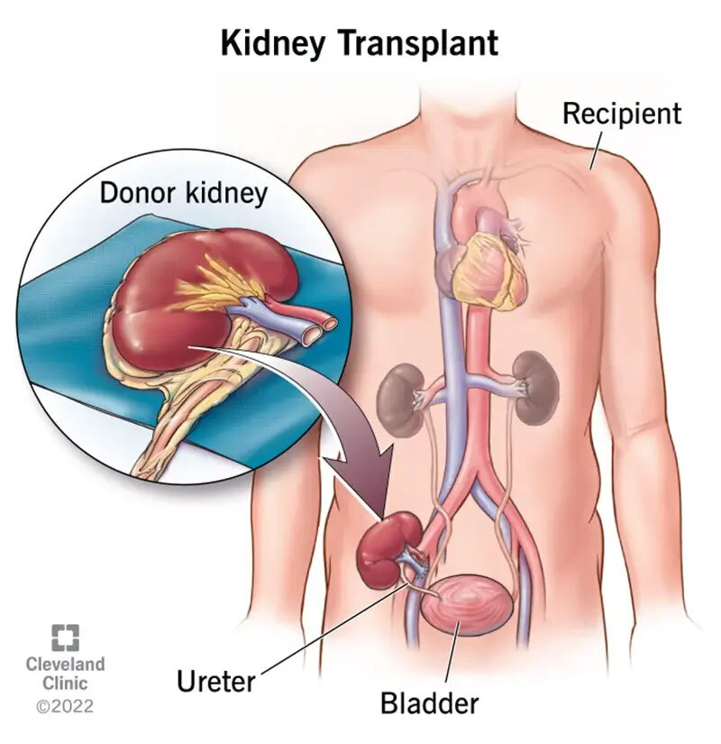 22537 kidney transplant