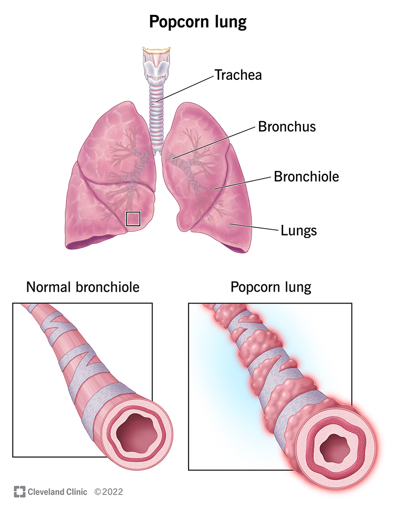 I bronchioli dei tuoi polmoni sono infiammati, cicatrizzati e danneggiati, hai la bronchiolite obliterante, chiamata anche polmone dei popcorn.