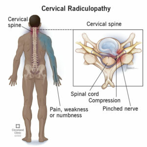 22639 cervical radiculopathy