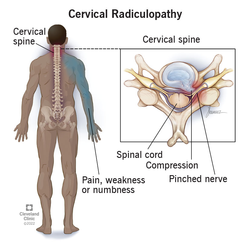 22639 cervical radiculopathy