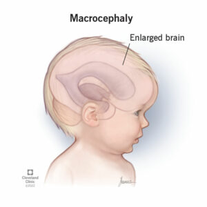 22685 macrocephaly