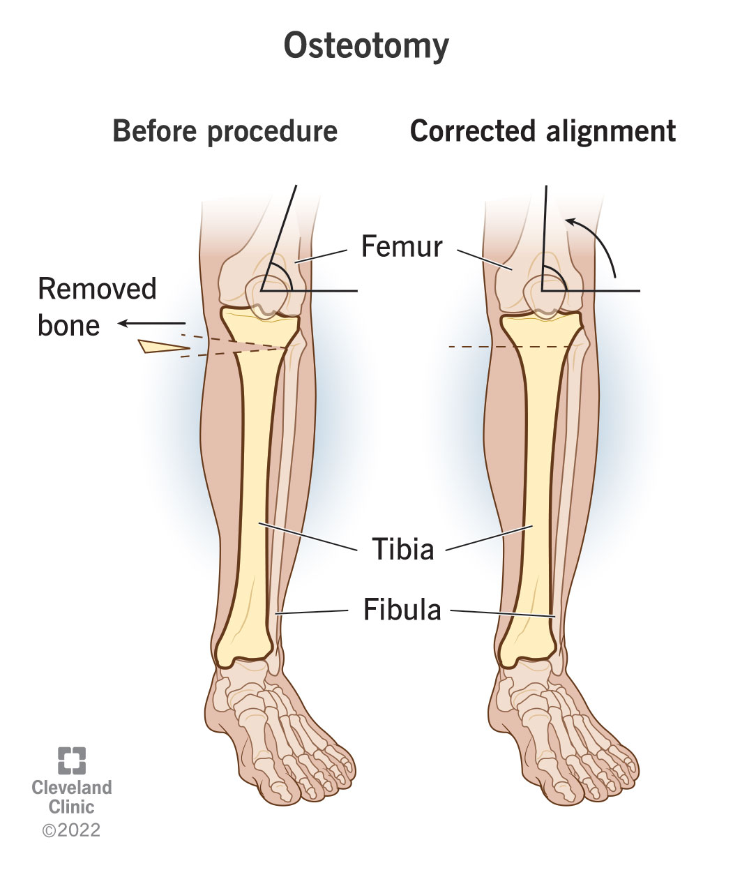 Prima e dopo l'osteotomia per rimodellare o riallineare l'osso.