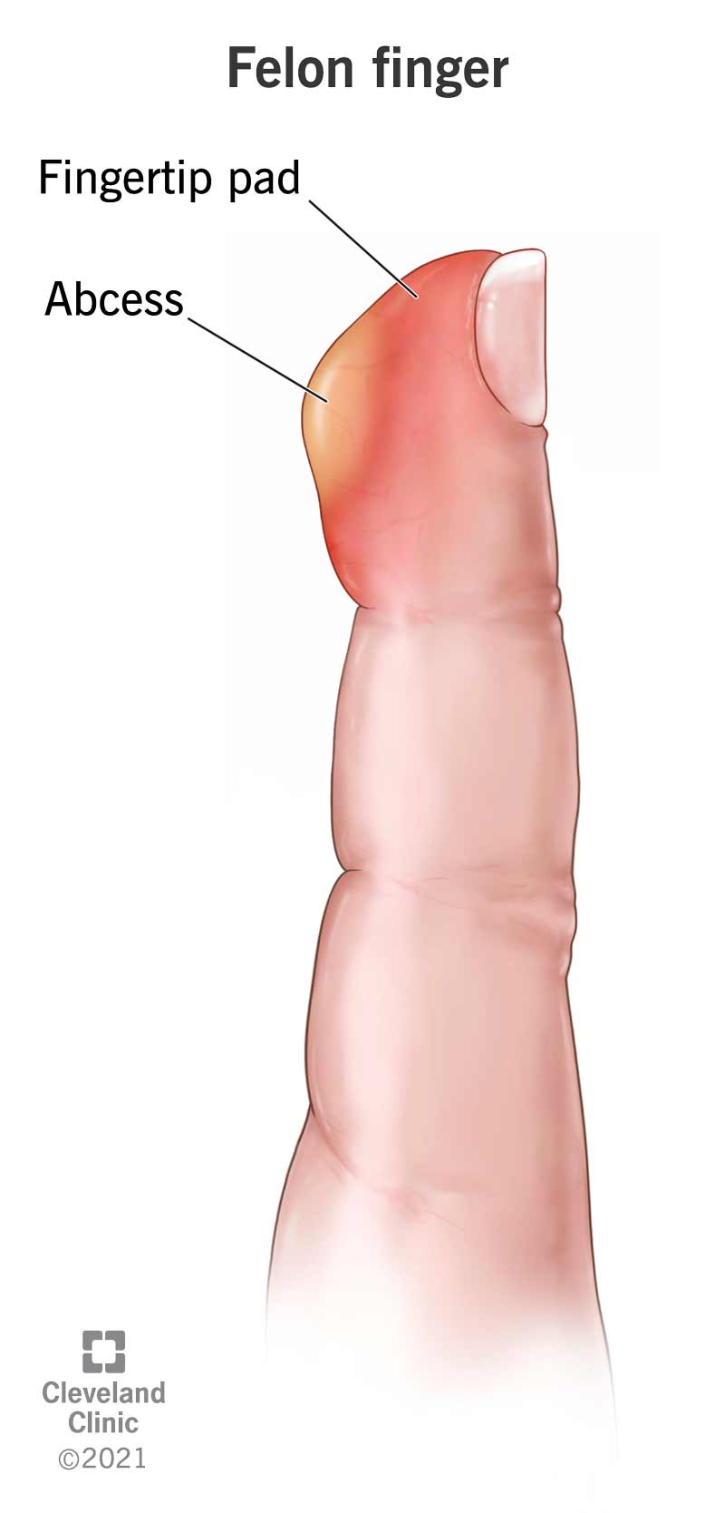 Un dito criminale è un'infezione dolorosa del polpastrello che può formare una sacca di pus (ascesso) all'interno del polpastrello