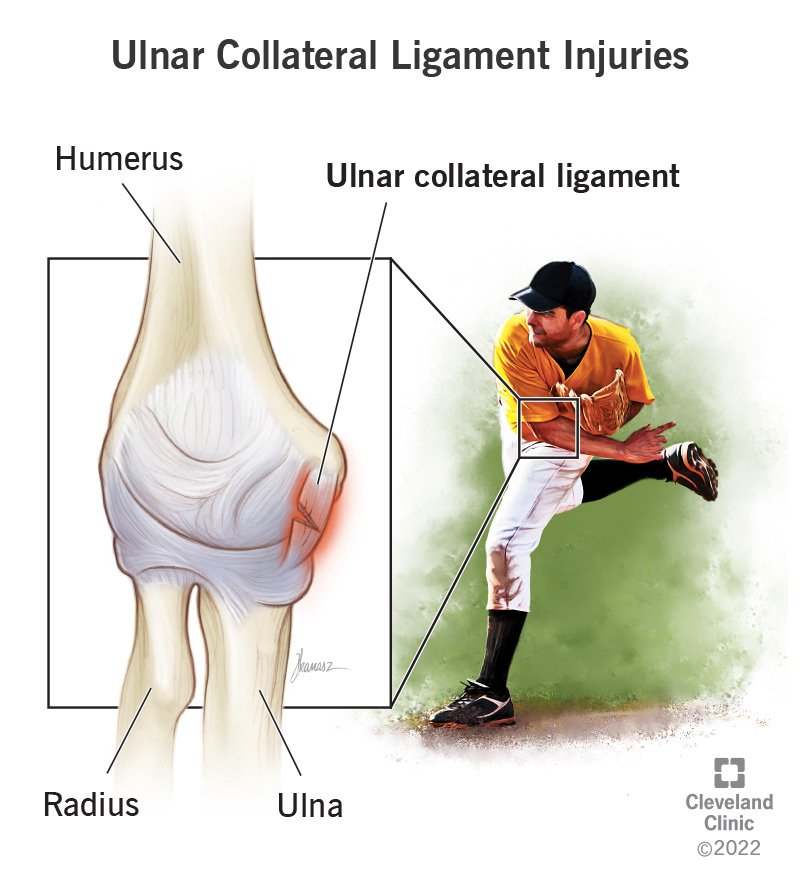 22760 ulnar collateral ligament injuries
