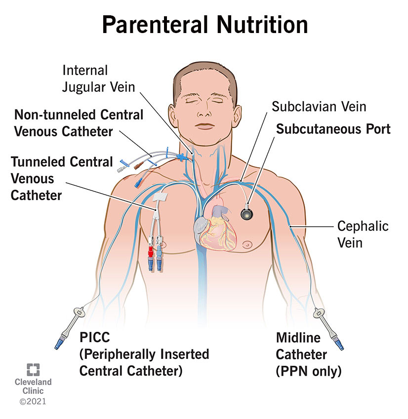 22802 parenteral nutrition