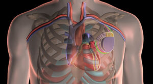 22936 cardiac resynchronization therapy