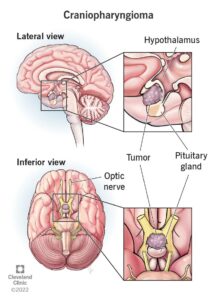 22989 craniopharyngioma