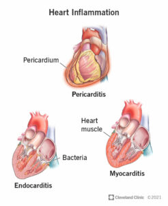 23052 heart inflammation