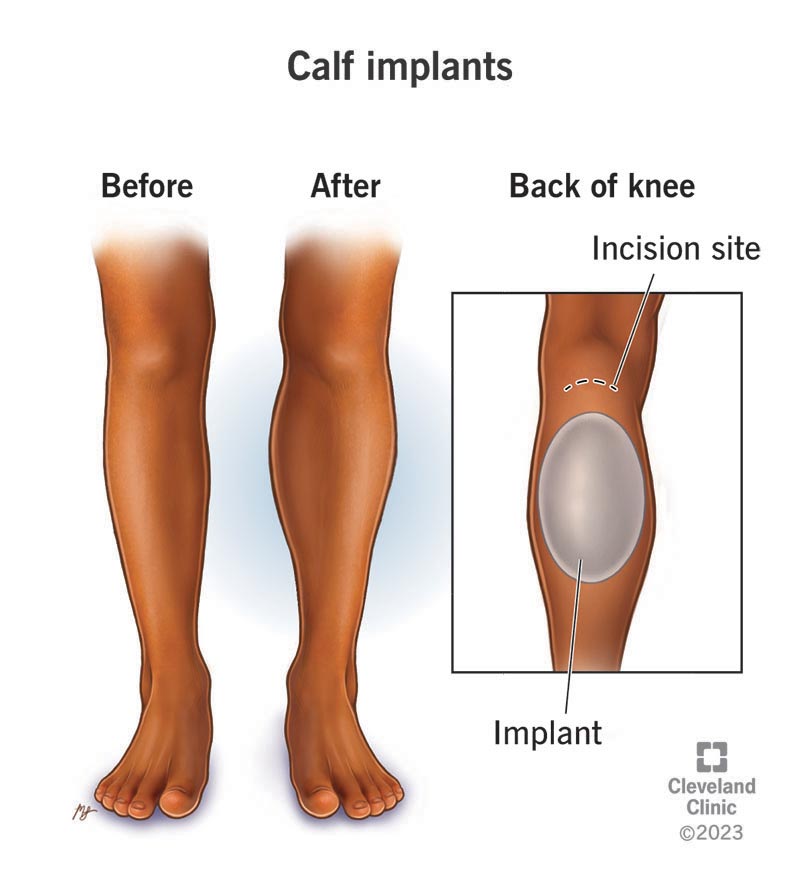 23253 calf implants