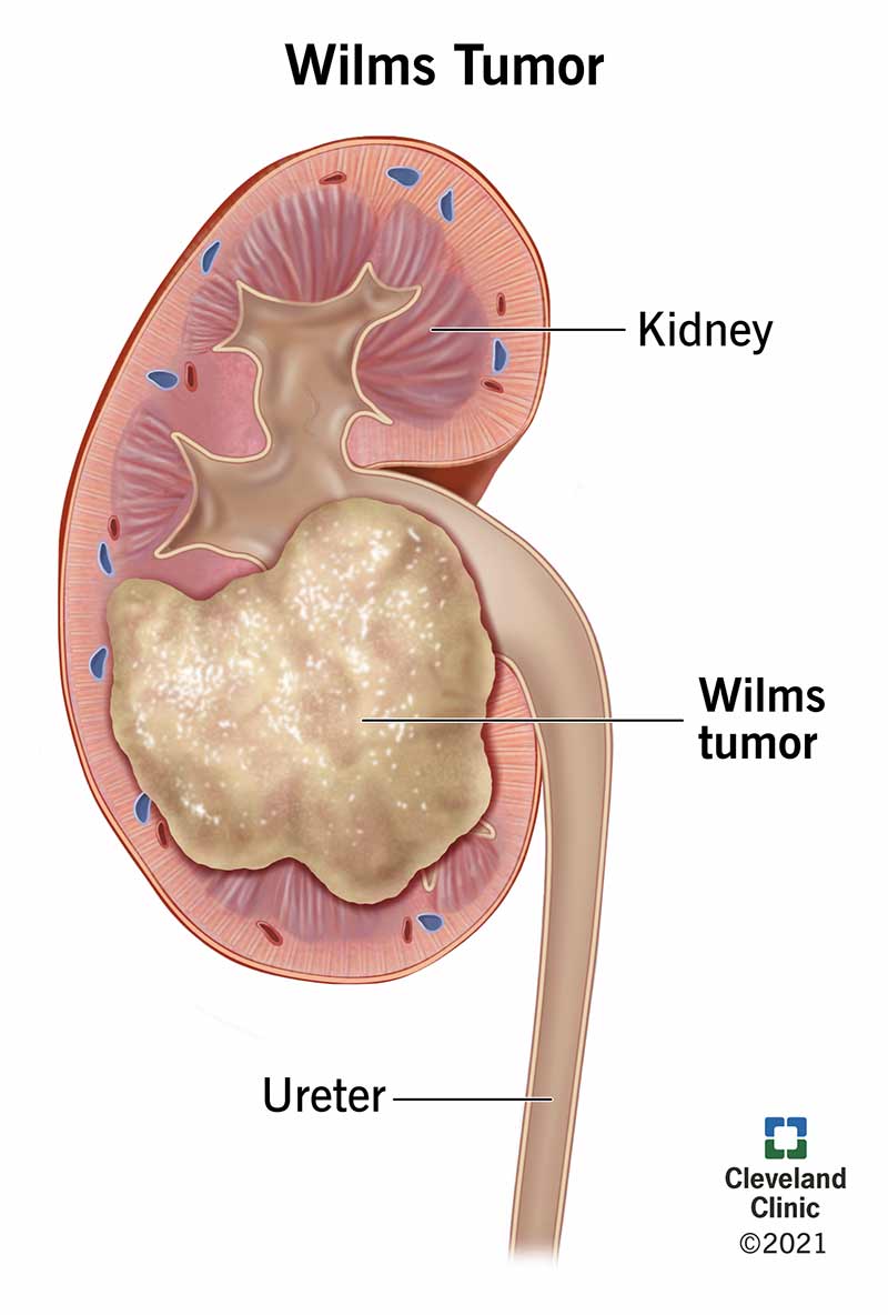 Un tumore di Wilms sta crescendo su un rene vicino all'uretere.