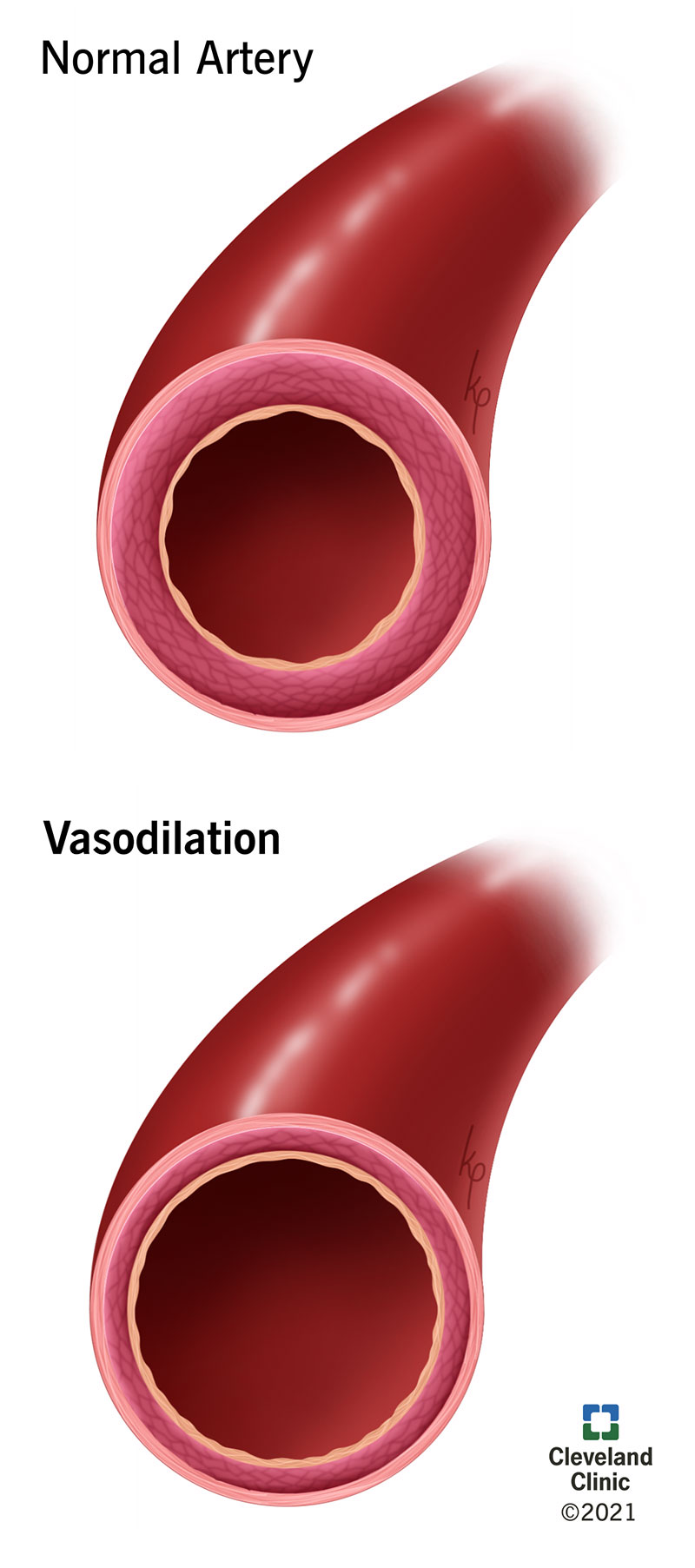 La vasodilatazione provoca l’allargamento del vaso sanguigno interessato, consentendo il flusso di più sangue.