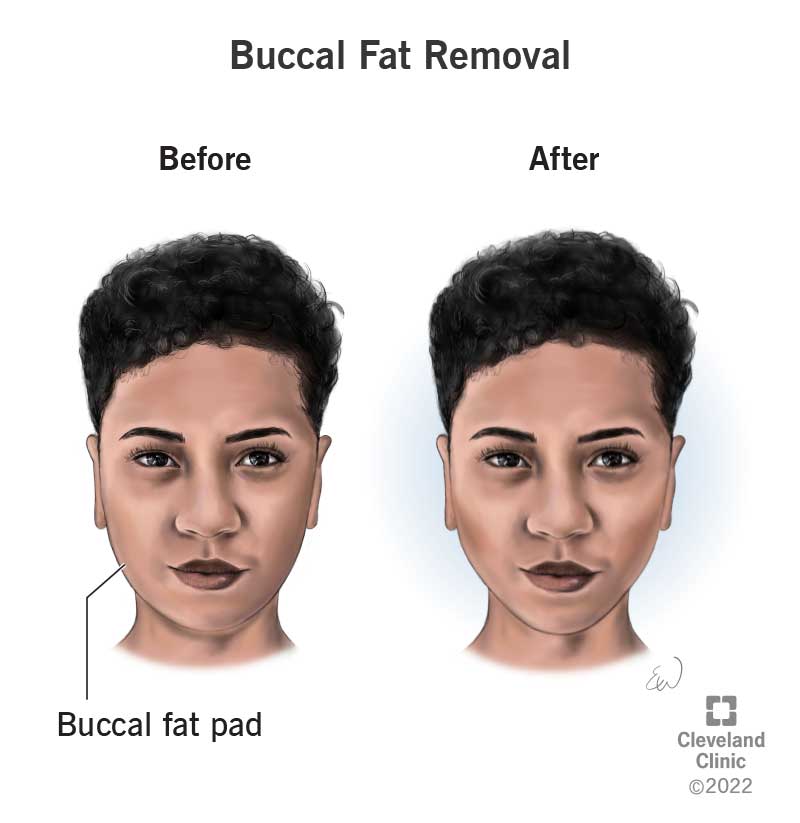 23396 buccal fat removal