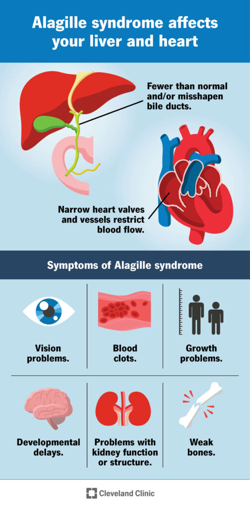 23540 alagille syndrome
