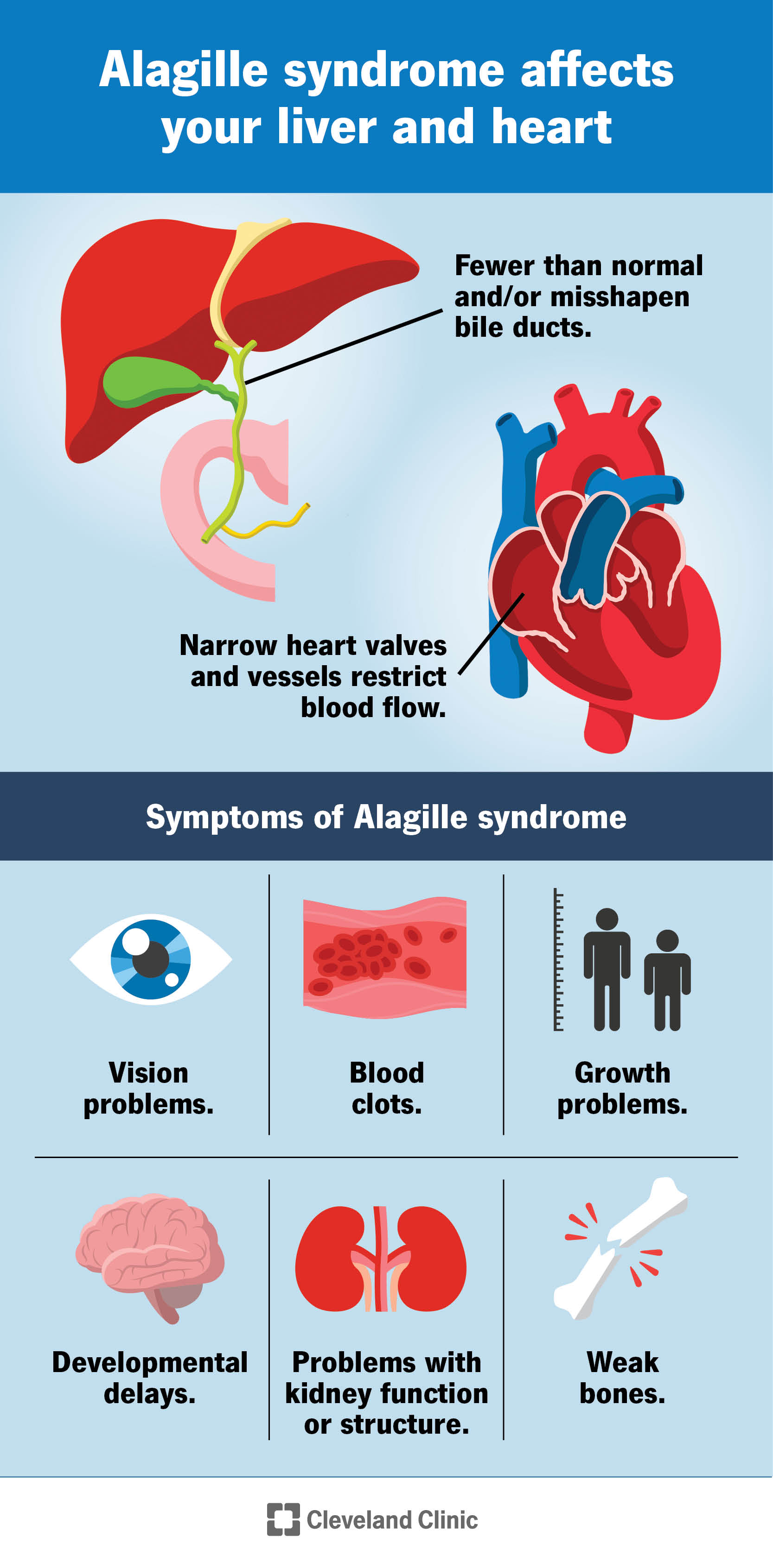 La sindrome di Alagille colpisce il cuore e il fegato e provoca altri sintomi in tutto il corpo.