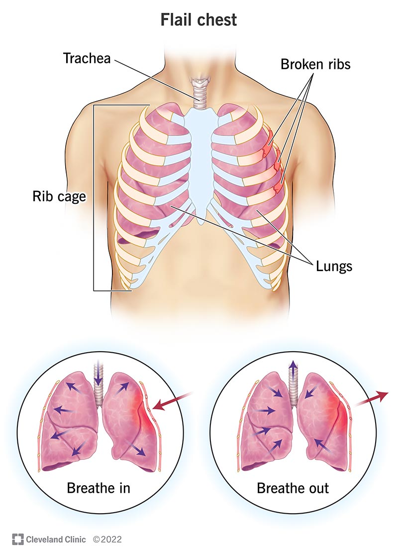 Illustrazione che mostra come le costole rotte interferiscono con la respirazione in una persona con torace flagellato.