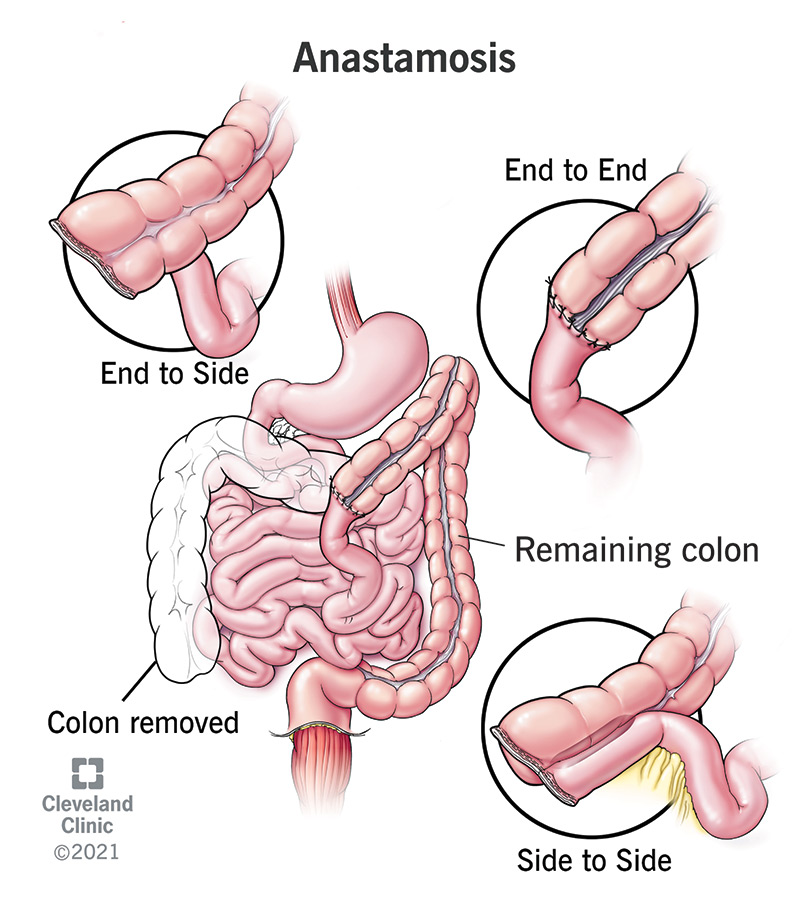 24035 anastamosis