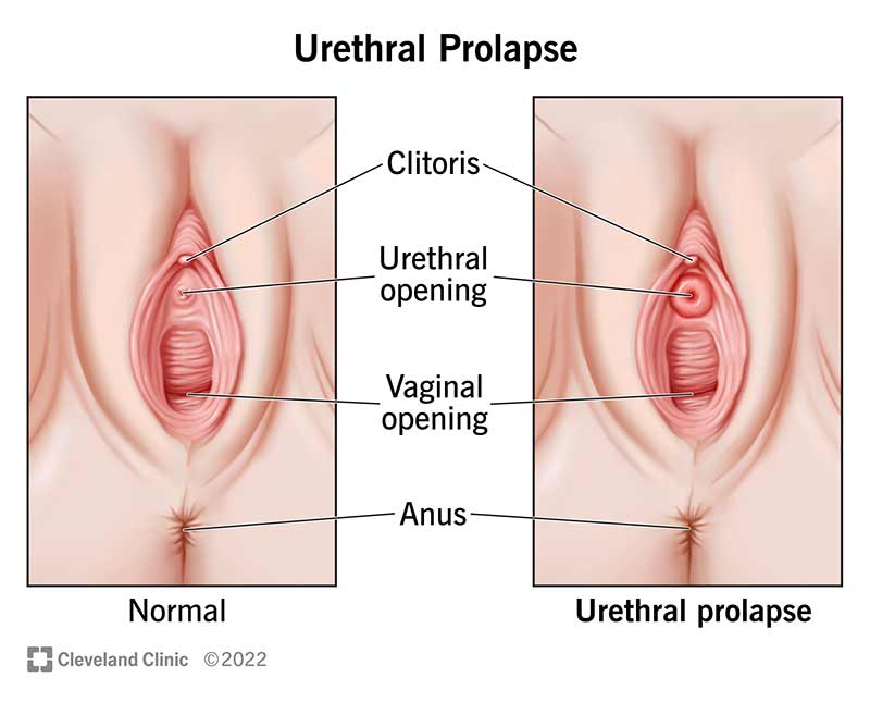 24177 urethral prolapse