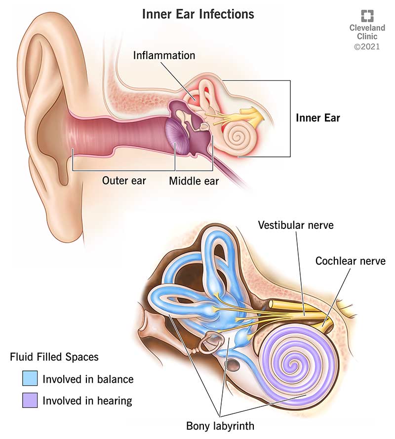 24240 inner ear infections