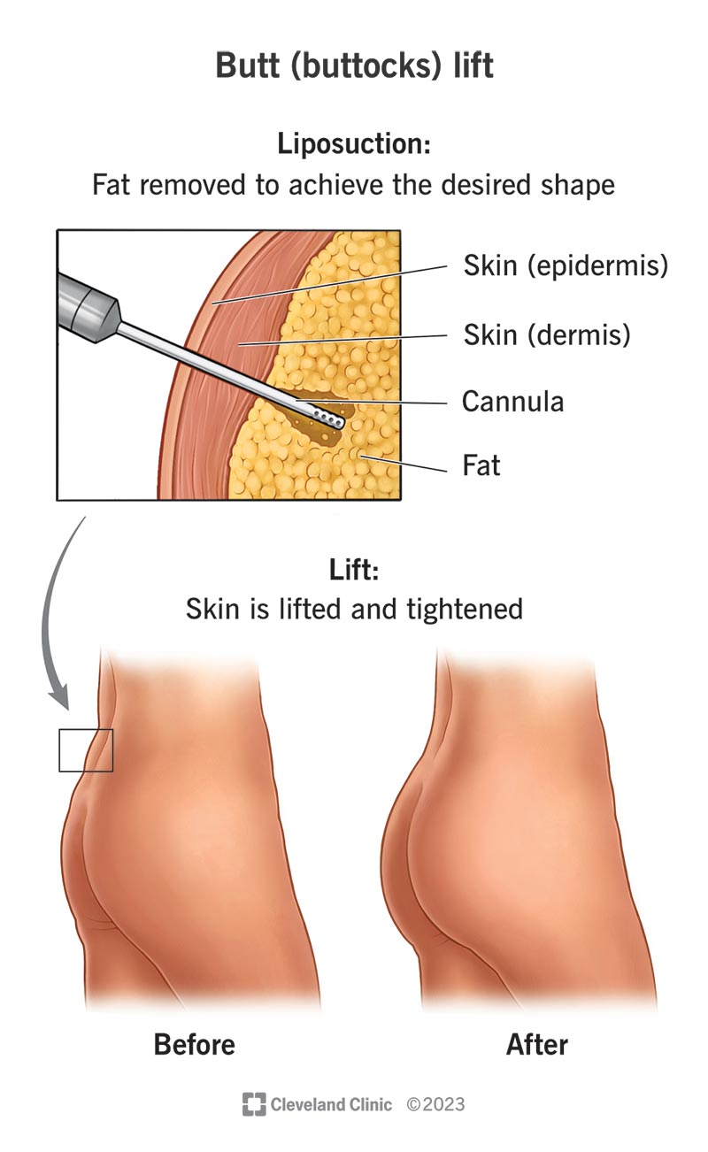 Lo strumento cannula per liposuzione nella pelle di una persona che un chirurgo utilizza per rimuovere il grasso.