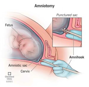 24270 amniotomy