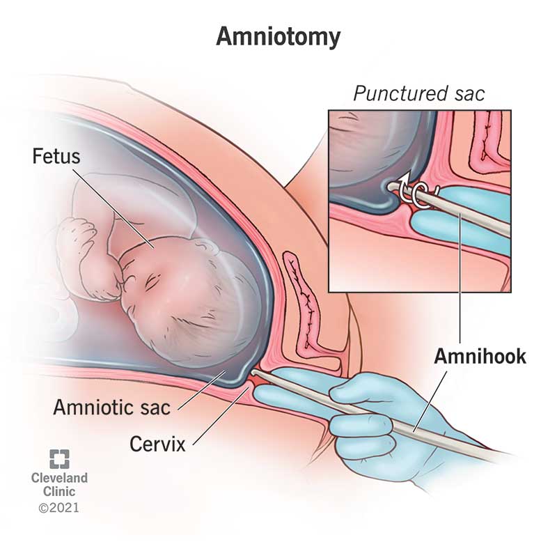 24270 amniotomy