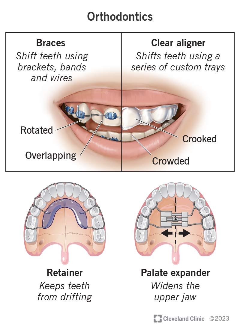 Apparecchi ortodontici, compresi apparecchi ortodontici, allineatori, contentori ed espansori del palato.