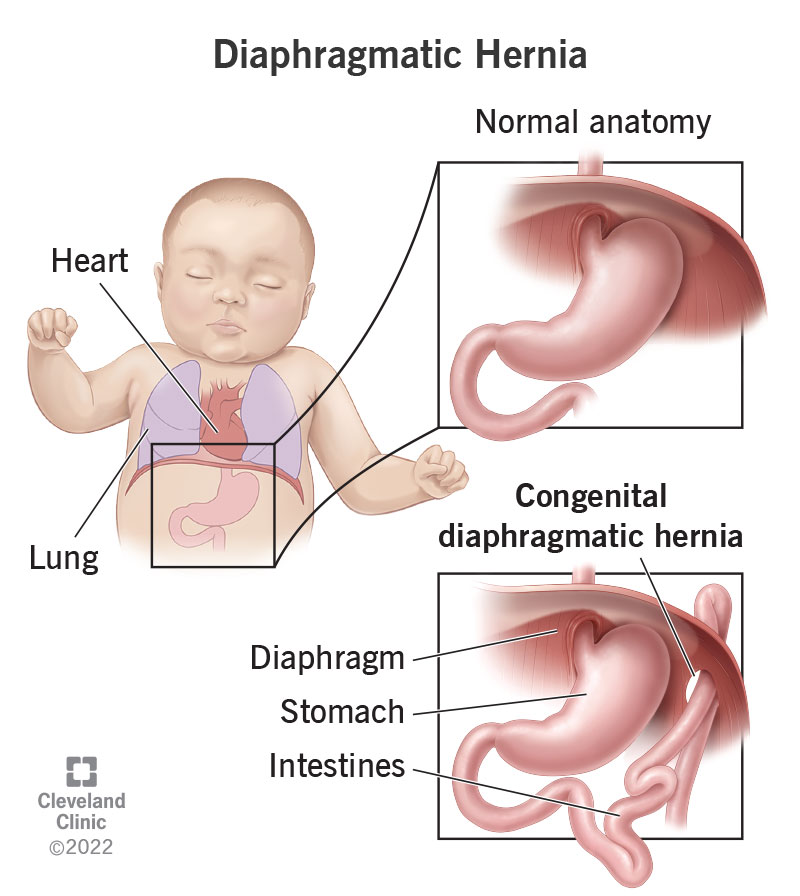 24308 diaphragmatic hernia