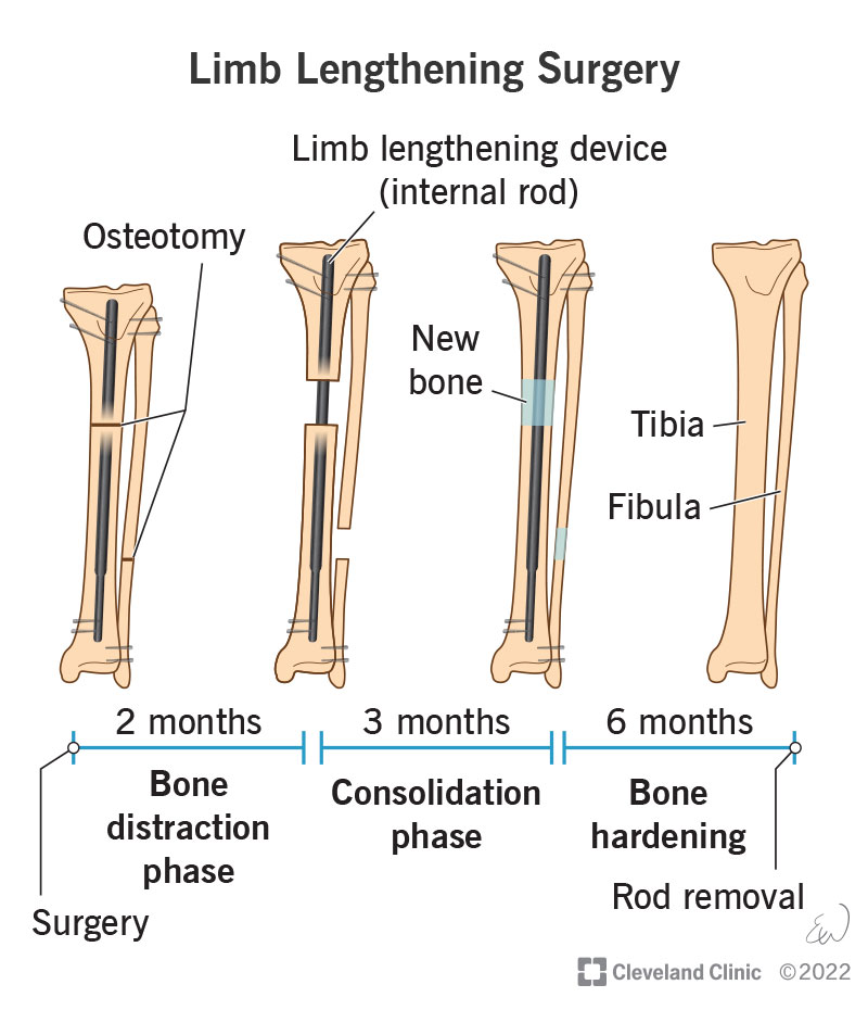 24316 limb lengthening surgery