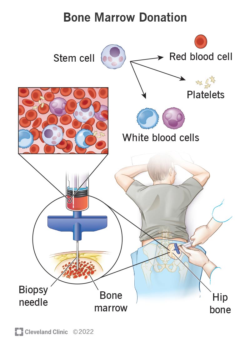 Operatore sanitario che preleva midollo osseo per il trapianto di cellule staminali.  Queste cellule staminali diventano globuli rossi, bianchi e piastrine.