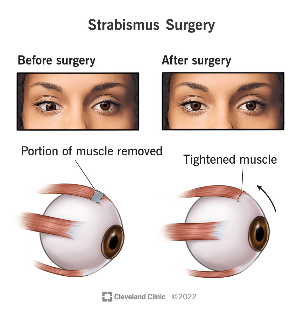 L’intervento chirurgico per lo strabismo può accorciare un muscolo dell’occhio e raddrizzare lo sguardo.