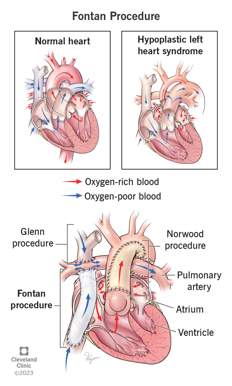 Una procedura Fontan consente al sangue povero di ossigeno dalla parte inferiore del corpo di raggiungere l'arteria polmonare, bypassando il cuore.