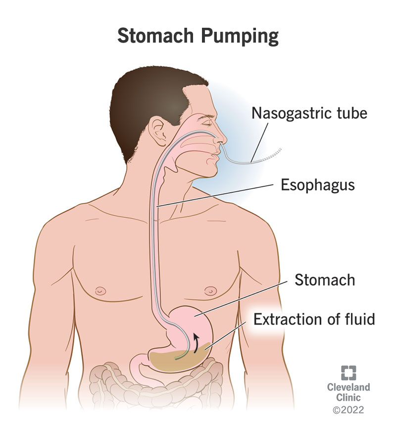 24587 stomach pumping