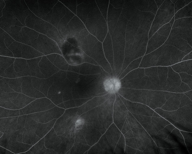 24618 fluorescein angiography