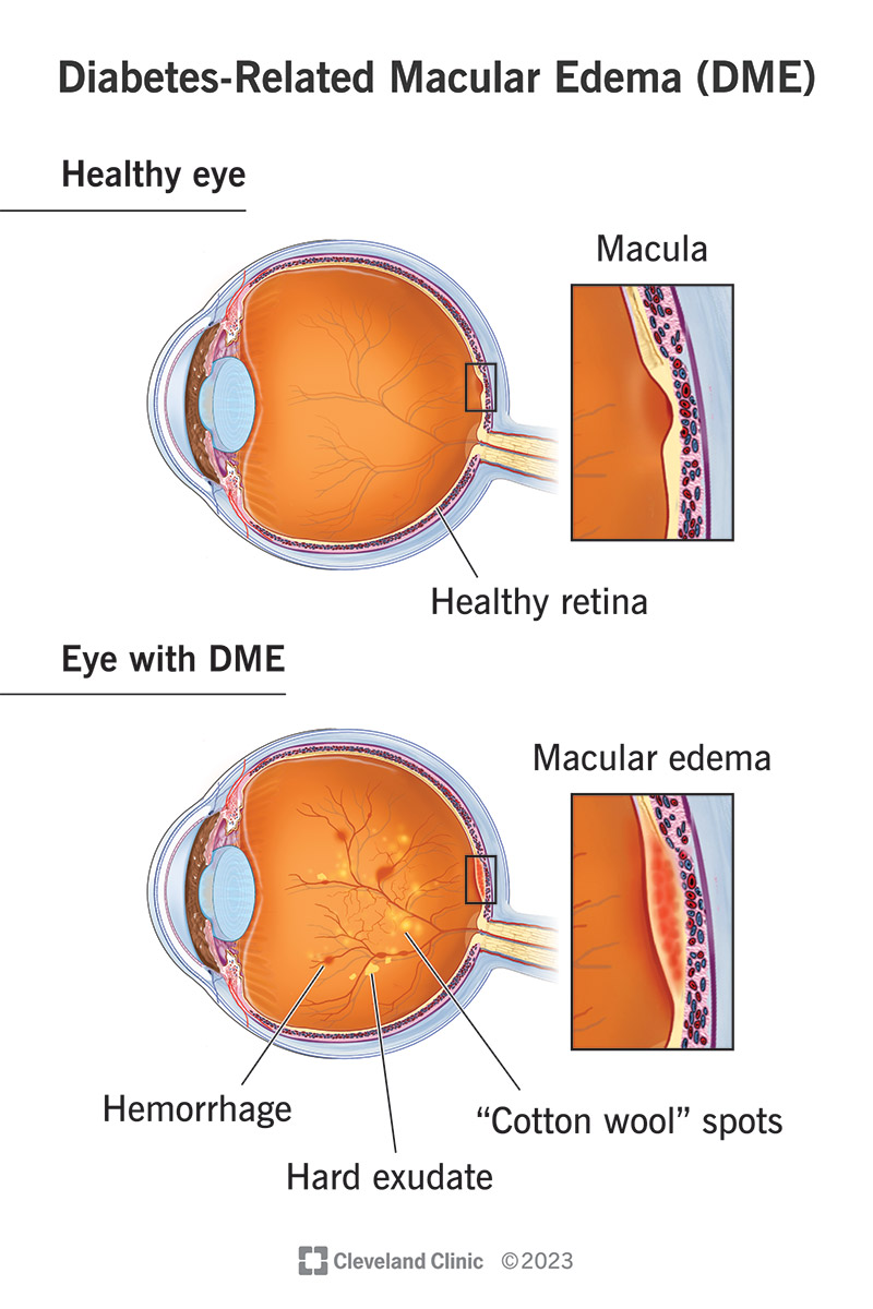 Una persona con edema maculare correlato al diabete può presentare gonfiore, emorragie, essudati duri e macchie di cotone negli occhi.