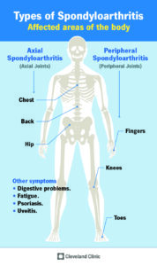 24843 axial spondyloarthritis infographic