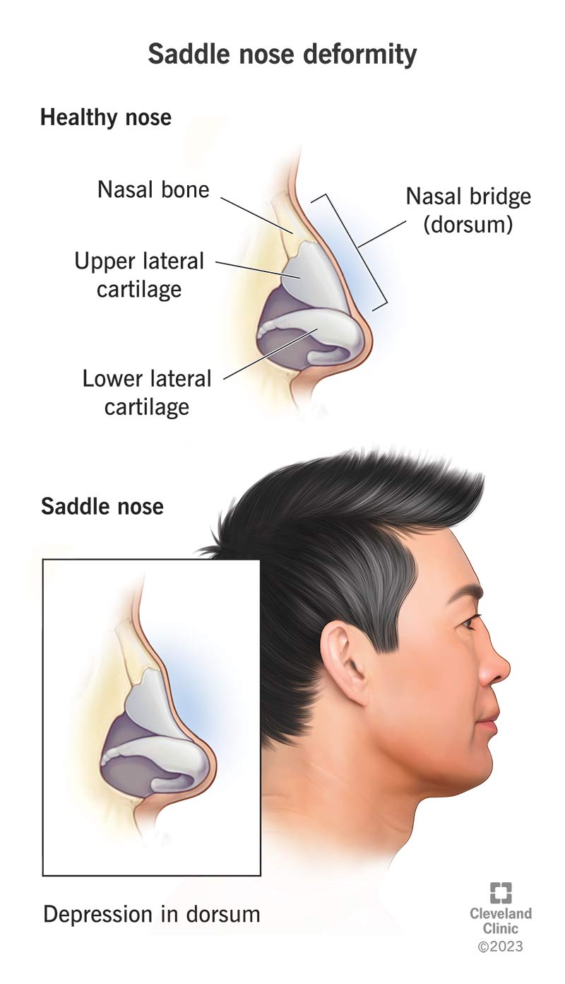 Deformità del naso a sella rispetto a naso sano, che mostra depressione nel dorso (ponte del naso).