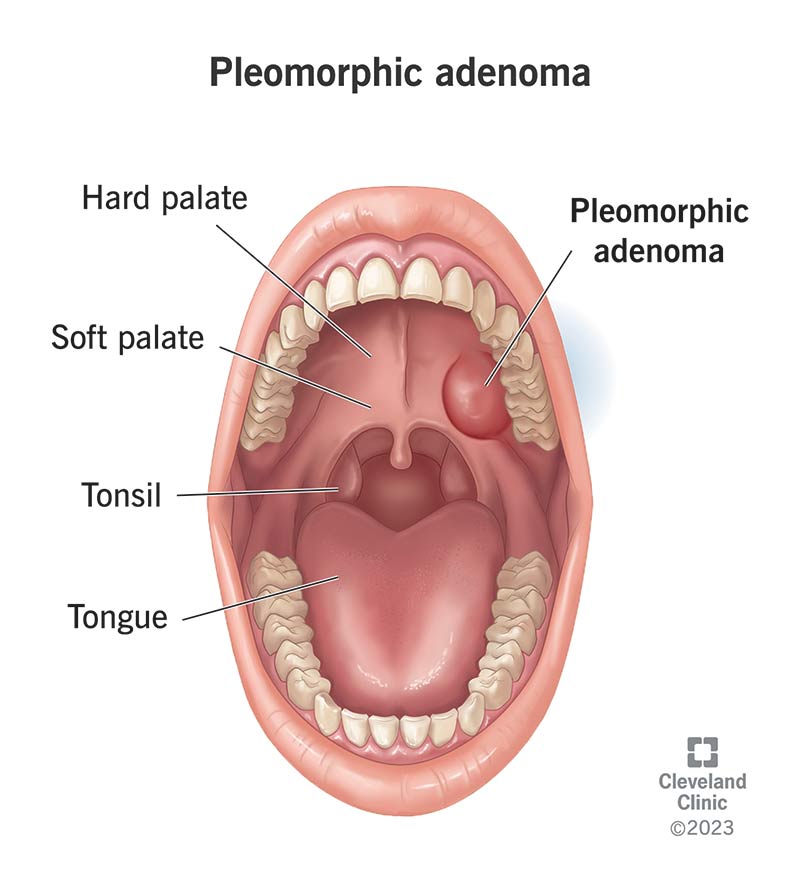 25073 pleomorphic adenoma