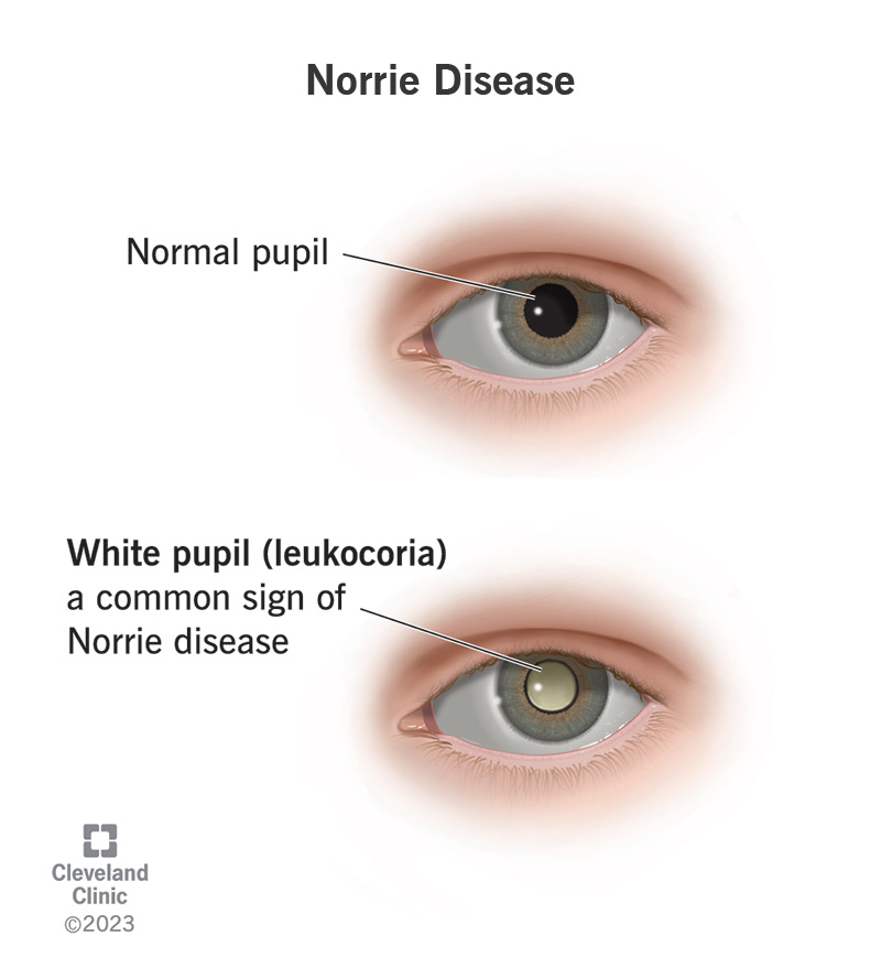 25143 norrie disease