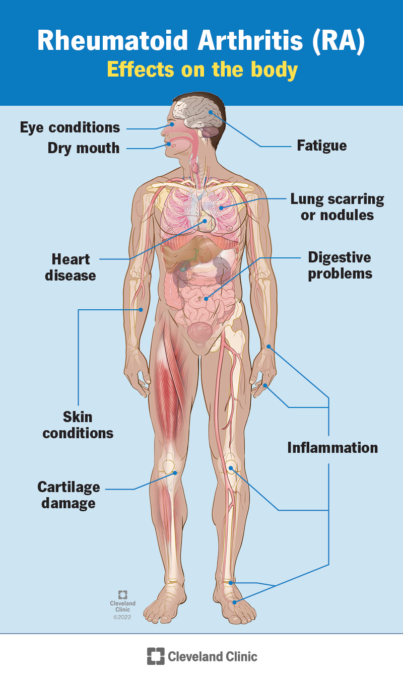L’artrite reumatoide colpisce molti sistemi del corpo.